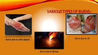 VARIOUS TYPES OF BURNS:-
 