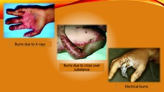 Burns due to X-rays
Electrical burns
 