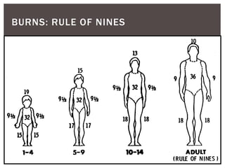 BURNS: RULE OF NINES
 