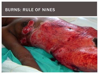 BURNS: RULE OF NINES
 