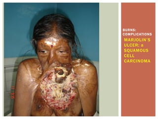 MARJOLIN’S
ULCER; a
SQUAMOUS
CELL
CARCINOMA
BURNS:
COMPLICATIONS
 