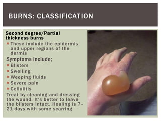 Second degree/Partial
thickness burns
 These include the epidermis
and upper regions of the
dermis
Symptoms include;
 Blisters
 Swelling
 Weeping fluids
 Severe pain
 Cellulitis
Treat by cleaning and dressing
the wound. It‘s better to leave
the blisters intact. Healing is 7-
21 days with some scarring
BURNS: CLASSIFICATION
 
