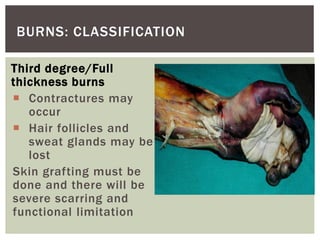Third degree/Full
thickness burns
 Contractures may
occur
 Hair follicles and
sweat glands may be
lost
Skin grafting must be
done and there will be
severe scarring and
functional limitation
BURNS: CLASSIFICATION
 