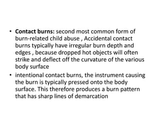 Burn | PPTX