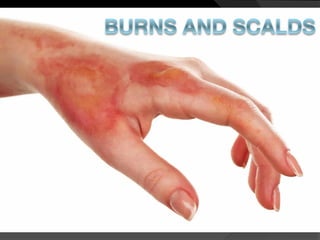 BURNS AND SCALDS
 