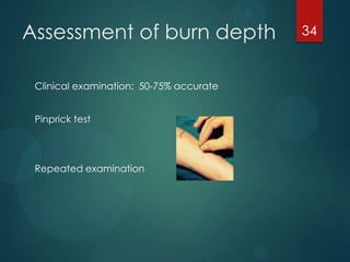 Assessment of burn depth
Clinical examination: 50-75% accurate

Pinprick test

Repeated examination

34

 