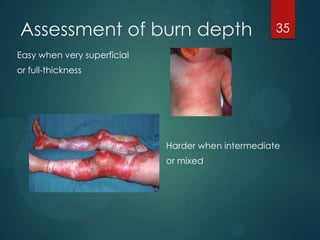 Assessment of burn depth

35

Easy when very superficial
or full-thickness

Harder when intermediate
or mixed

 