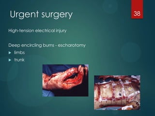 Urgent surgery
High-tension electrical injury
Deep encircling burns - escharotomy


limbs



trunk

38

 