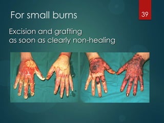 For small burns
Excision and grafting
as soon as clearly non-healing

39

 