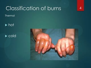 Classification of burns
Thermal



hot



cold

4

 