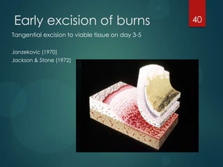 Early excision of burns
Tangential excision to viable tissue on day 3-5
Janzekovic (1970)
Jackson & Stone (1972)

40

 