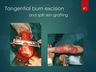 Tangential burn excision
and split skin grafting

41

 