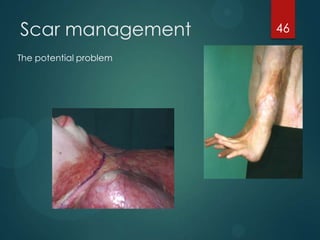 Scar management
The potential problem

46

 