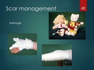 Scar management
Splintage

48

 