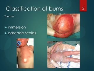 Classification of burns
Thermal



immersion



cascade scalds

5

 