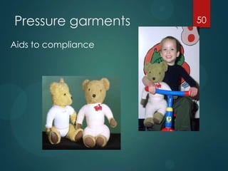 Pressure garments
Aids to compliance

50

 