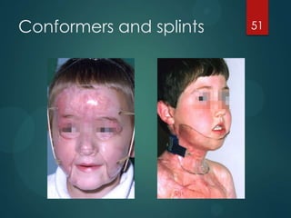 Conformers and splints

51

 
