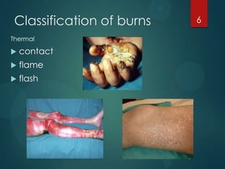 Classification of burns
Thermal



contact



flame



flash

6

 