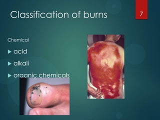 Classification of burns
Chemical



acid



alkali



organic chemicals

7

 