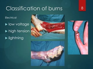 Classification of burns
Electrical



low voltage



high tension



lightning

8

 