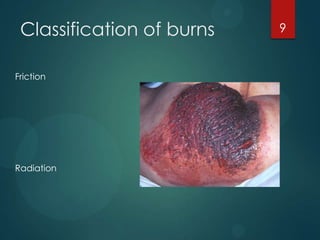 Classification of burns
Friction

Radiation

9

 
