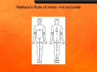 Wallace’s Rule of nines -not accurate
 