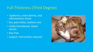 Full-Thickness (Third Degree)
• Epidermis, entire dermis, and
subcutaneous tissue
• Dry; pale white, Leathery skin
• visible thrombosed blood
vessels
• Pain free
• surgical intervention required
 