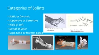 Categories of Splints
• Static or Dynamic
• Supportive or Corrective
• Rigid or soft
• Dorsal or Volar
• Digit, hand or forearm based
 