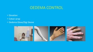 OEDEMA CONTROL
• Elevation
• Coban wrap
• Oedema Glove/Digi Sleeve
 