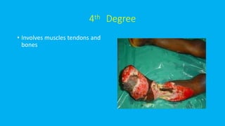 4th Degree
• Involves muscles tendons and
bones
 