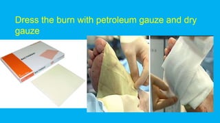 Dress the burn with petroleum gauze and dry
gauze
 