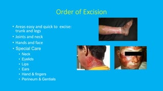 Order of Excision
• Areas easy and quick to excise:
trunk and legs
• Joints and neck
• Hands and face
• Special Care
• Neck
• Eyelids
• Lips
• Ears
• Hand & fingers
• Perineum & Gentials
 