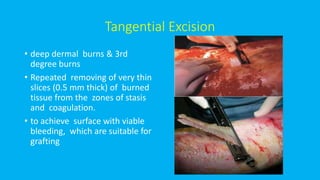 Tangential Excision
• deep dermal burns & 3rd
degree burns
• Repeated removing of very thin
slices (0.5 mm thick) of burned
tissue from the zones of stasis
and coagulation.
• to achieve surface with viable
bleeding, which are suitable for
grafting
 