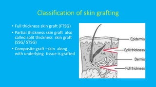 Classification of skin grafting
• Full thickness skin graft (FTSG)
• Partial thickness skin graft also
called split thickness skin graft
(SSG/ STSG)
• Composite graft –skin along
with underlying tissue is grafted
 