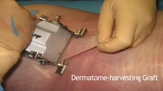 Dermatome-harvesting Graft
 