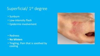 Superficial/ 1st degree
• Sunburn
• Low-intensity flash
• Epidermis involvement
• Redness
• No blisters
• Tingling, Pain that is soothed by
cooling
 