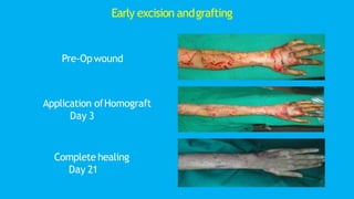 Pre-Op wound
Application ofHomograft
Day 3
Complete healing
Day 21
Early excision andgrafting
 