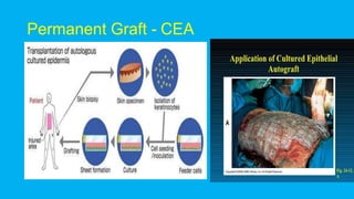 Permanent Graft - CEA
 