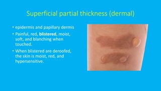 Superficial partial thickness (dermal)
• epidermis and papillary dermis
• Painful, red, blistered, moist,
soft, and blanching when
touched.
• When blistered are deroofed,
the skin is moist, red, and
hypersensitive.
 