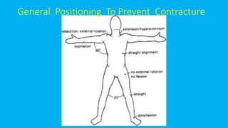 General Positioning To Prevent Contracture
 