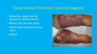 Deep Partial-Thickness (Second Degree)
• Epidermis, upper dermis,
portion of deeper dermis
• Blisters that are red, shiny.
• Severe pain caused by nerve
injury
• edema
 