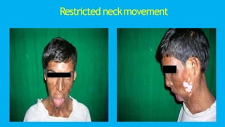 Restricted neckmovement
 