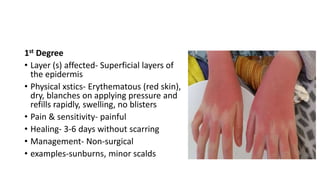 1st Degree
• Layer (s) affected- Superficial layers of
the epidermis
• Physical xstics- Erythematous (red skin),
dry, blanches on applying pressure and
refills rapidly, swelling, no blisters
• Pain & sensitivity- painful
• Healing- 3-6 days without scarring
• Management- Non-surgical
• examples-sunburns, minor scalds
 