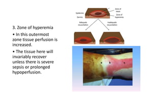 3. Zone of hyperemia
• In this outermost
zone tissue perfusion is
increased.
• The tissue here will
invariably recover
unless there is severe
sepsis or prolonged
hypoperfusion.
 