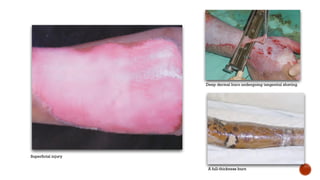 Deep dermal burn undergoing tangential shaving.
A full-thickness burn
Superficial injury
 