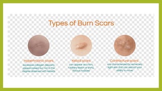 Burns - types, evaluation and occupational therapy | PPTX