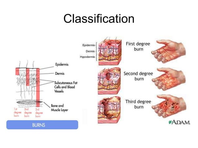 Burns in Children PPT Burns in Children PPT
