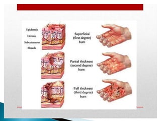 Significant Burn burns for first aid management ppt.pptx