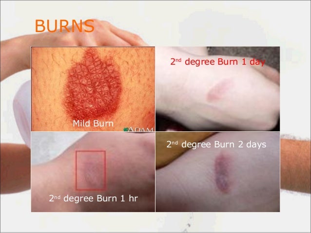 difference between 1st degree burn and 2nd