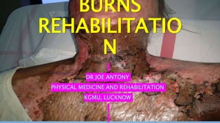 BURNS
REHABILITATIO
N
DR JOE ANTONY
PHYSICAL MEDICINE AND REHABILITATION
KGMU, LUCKNOW
1
 